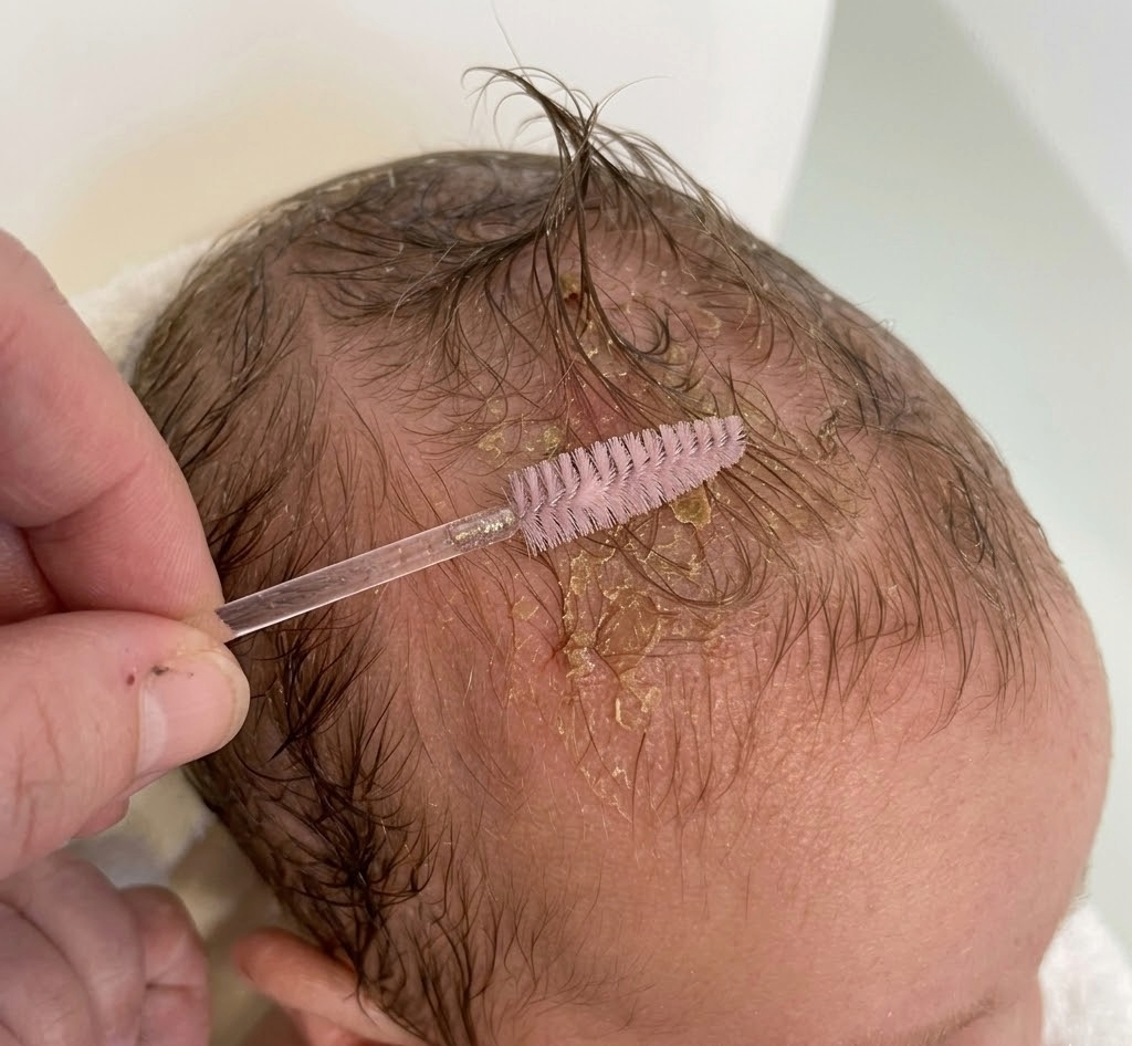 Is the Spoolie Cradle Cap Trend Safe? What Parents Should Know