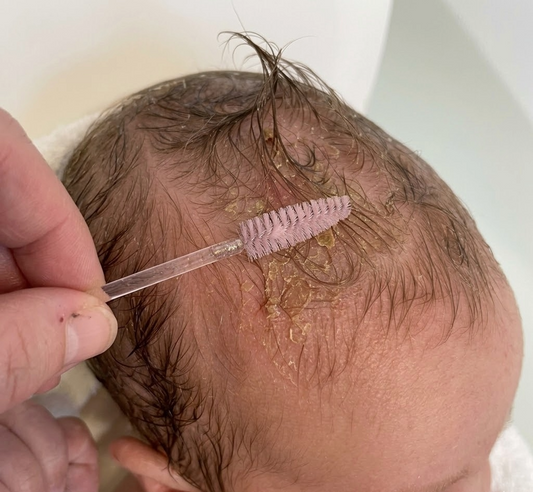Is the Spoolie Cradle Cap Trend Safe? What Parents Should Know